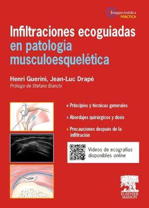 Infiltraciones ecoguiadas en patologia musculoesqueletica